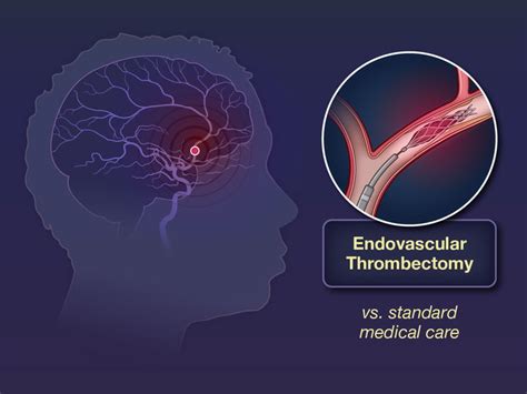 Building evidence on safety of endovascular thrombectomy for .